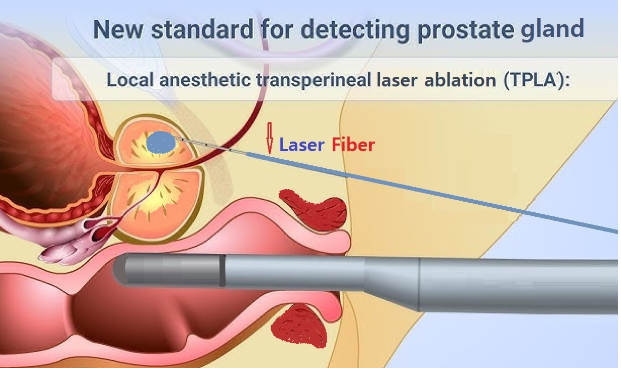 MÁY LASER ĐIỀU TRỊ PHÌ ĐẠI TIỀN LIỆT TUYẾN LÀNH TÍNH