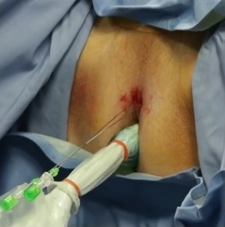 MÁY LASER ĐIỀU TRỊ PHÌ ĐẠI TIỀN LIỆT TUYẾN LÀNH TÍNH