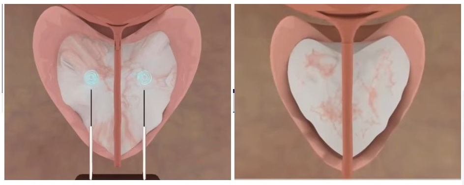 MÁY LASER ĐIỀU TRỊ PHÌ ĐẠI TIỀN LIỆT TUYẾN LÀNH TÍNH