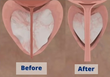 MÁY LASER ĐIỀU TRỊ PHÌ ĐẠI TIỀN LIỆT TUYẾN LÀNH TÍNH