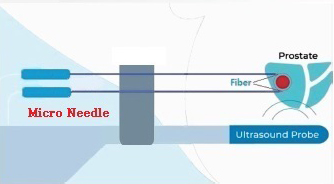 MÁY LASER ĐIỀU TRỊ PHÌ ĐẠI TIỀN LIỆT TUYẾN 