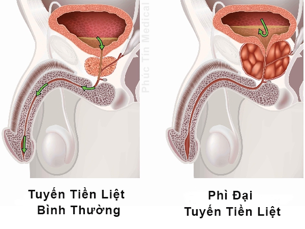 Bệnh Phì Đại Tiền Liệt Tuyến (BPH)